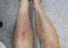 男子蹚水竟染上丹毒！雨天户外行走指南请查收